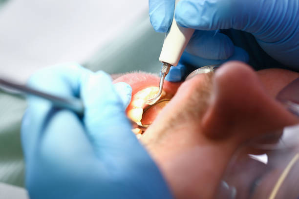 Best Emergency Wisdom Teeth Removal in Hudson Oaks, TX